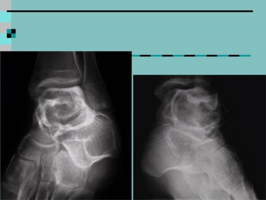 最新右腓骨下端骨囊肿ppt课件_第5页