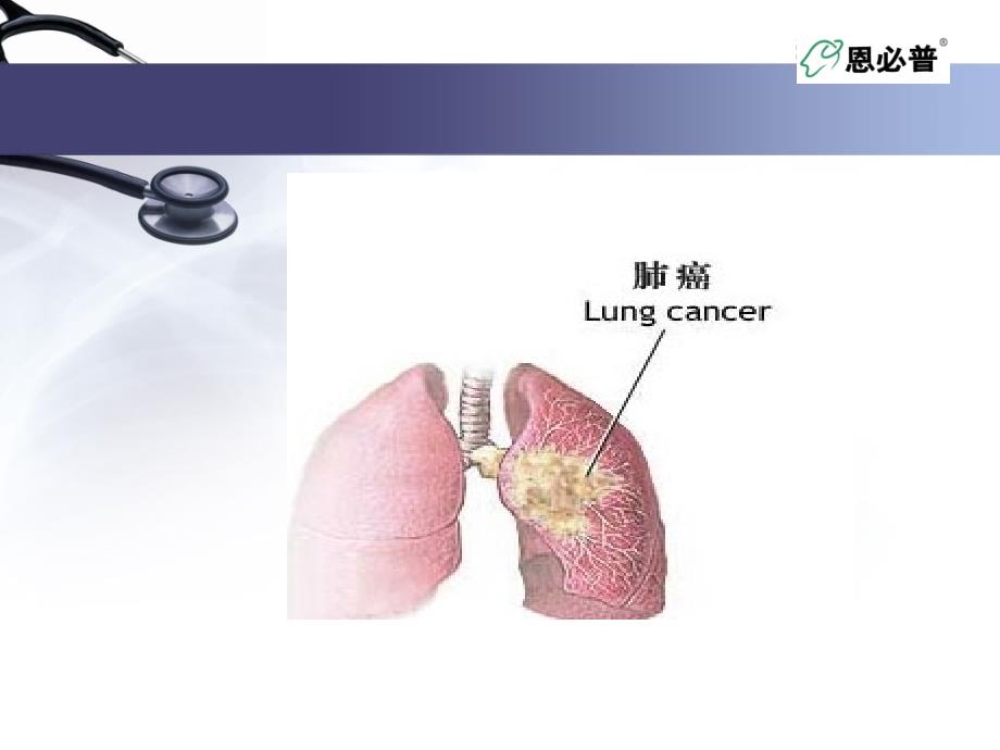 全肺切除术后的液体治疗及护理要点.ppt_第4页