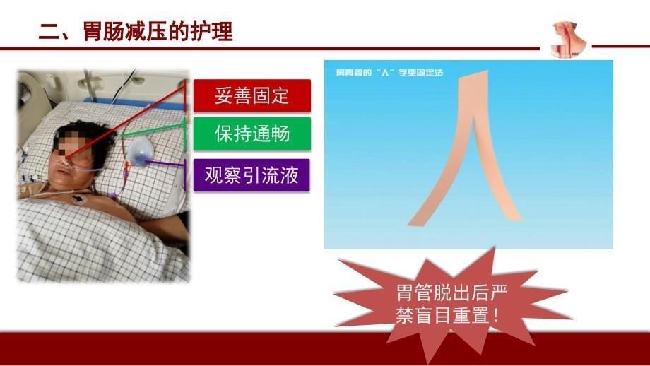 食管癌患者术后护理.ppt_第5页