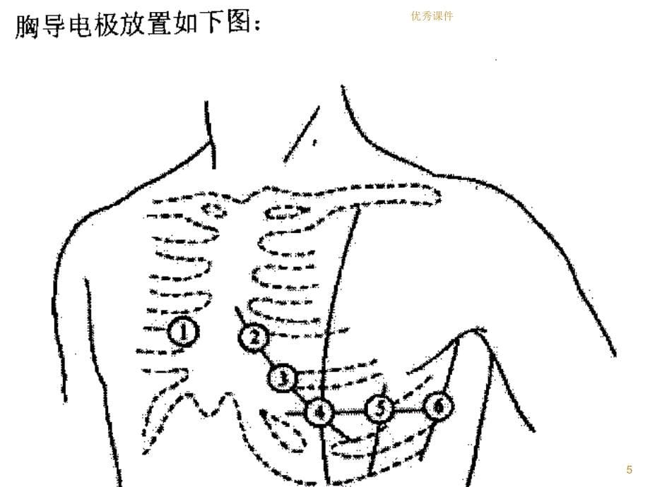 急诊常见异常心电图及抢救应对【医疗资料】_第5页