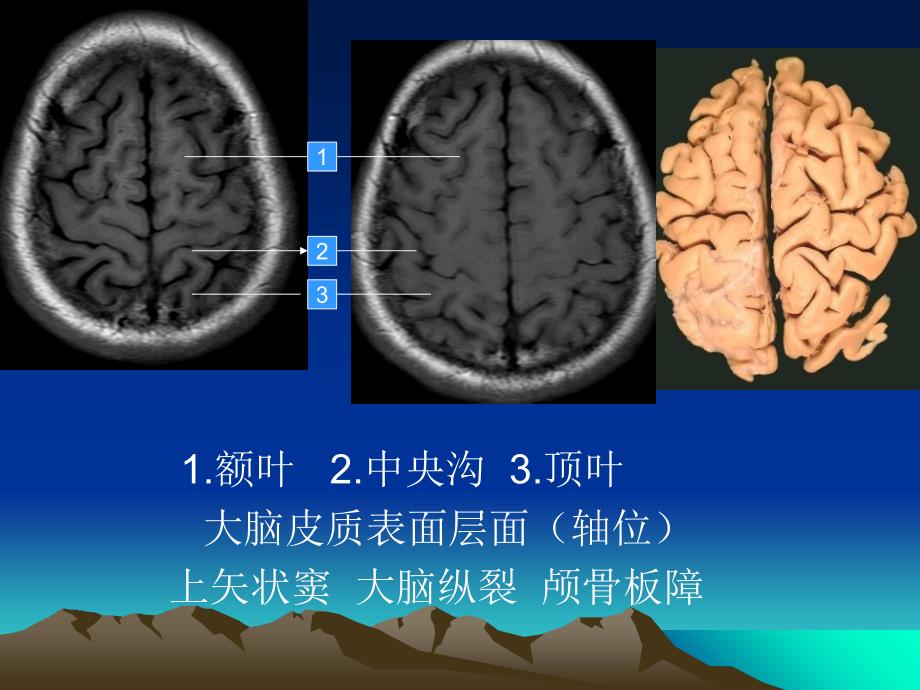 头颅MRI断层解剖_第3页