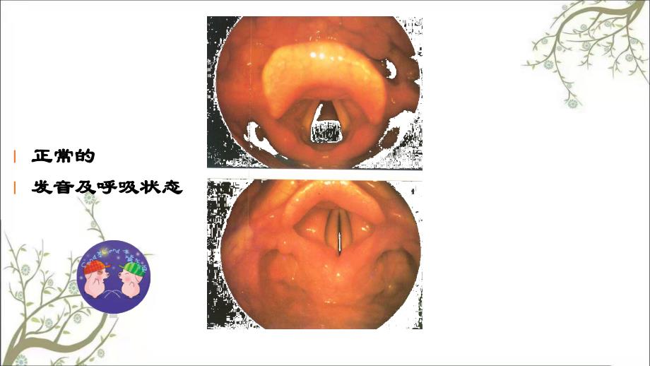 喉阻塞与急救课件_第3页