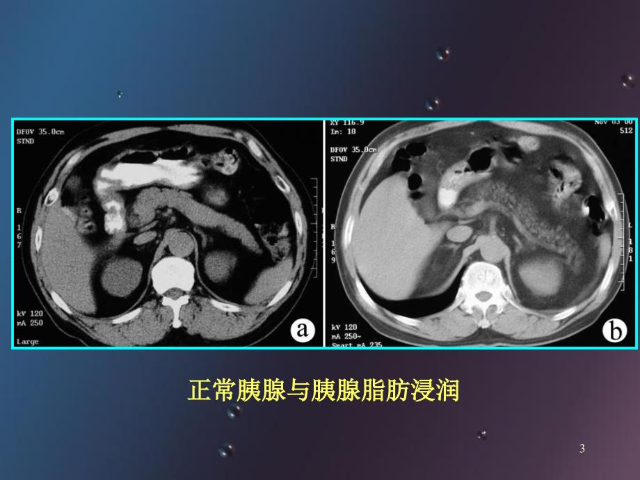 胰腺常见病变的CT诊断_第3页