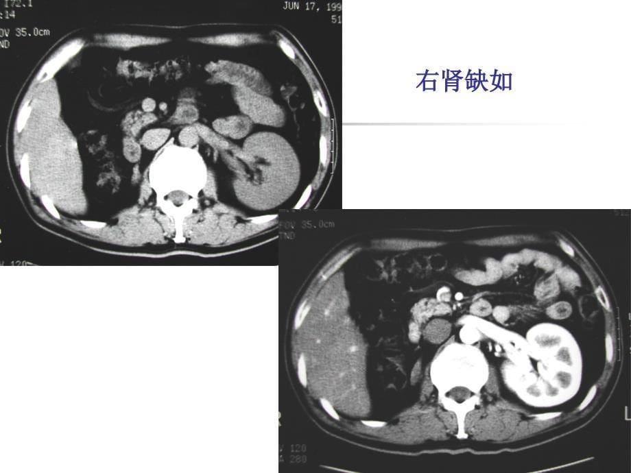 2泌尿系变异及发育异常_第5页