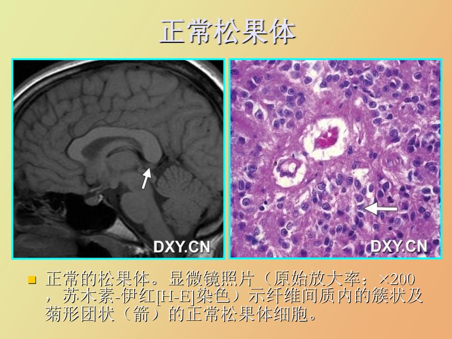 松果体区病变影像诊断_第4页