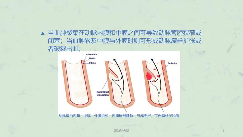 颈动脉夹层课件_第3页