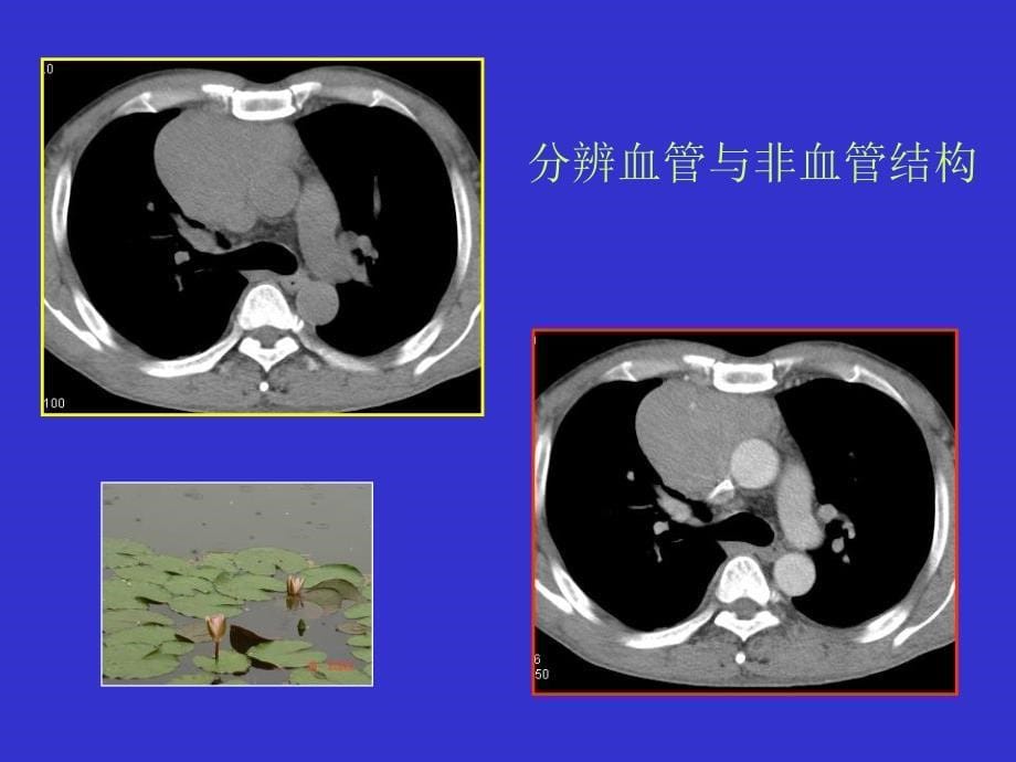 肺癌CT征象的观察与分析_第5页