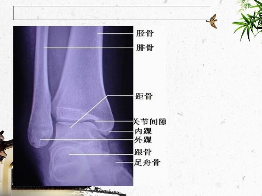 踝关节骨折的护理_第5页