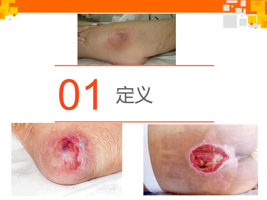 压疮的预防及护理健康教育.ppt_第1页