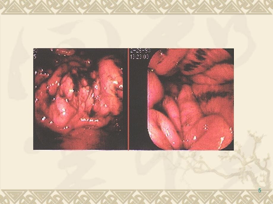 急性胃炎消化系统ppt课件_第5页