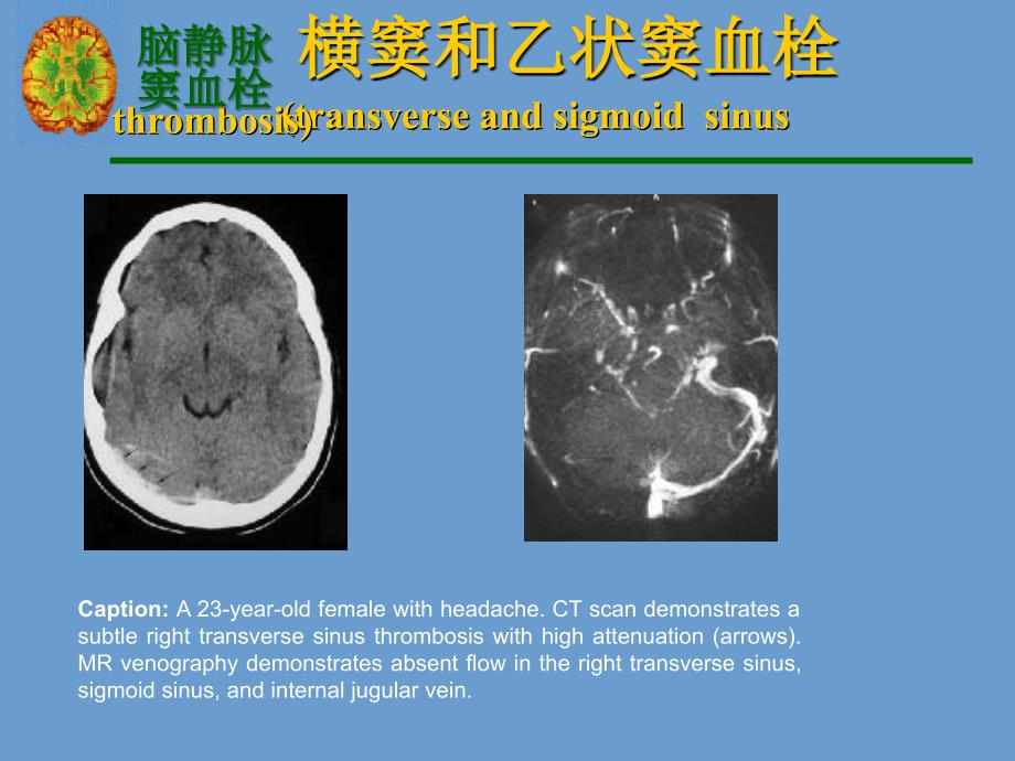 宣武颅内静脉系血栓幻灯2_第3页