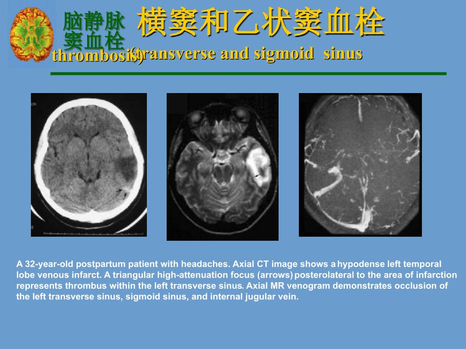 宣武颅内静脉系血栓幻灯2_第4页