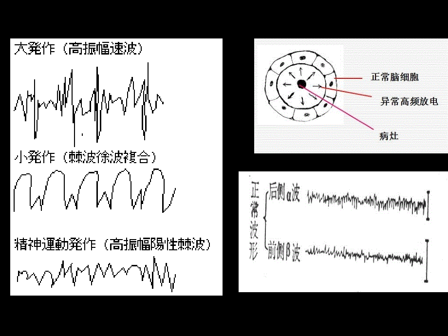 抗癫痫和抗惊厥课件_第3页