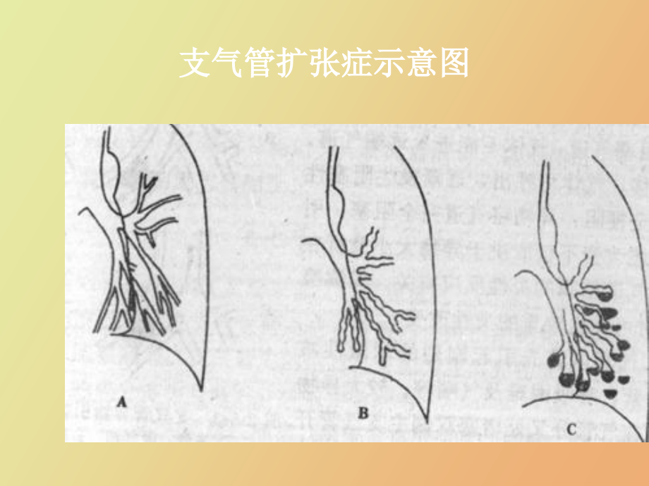 肺部疾病诊断_第4页