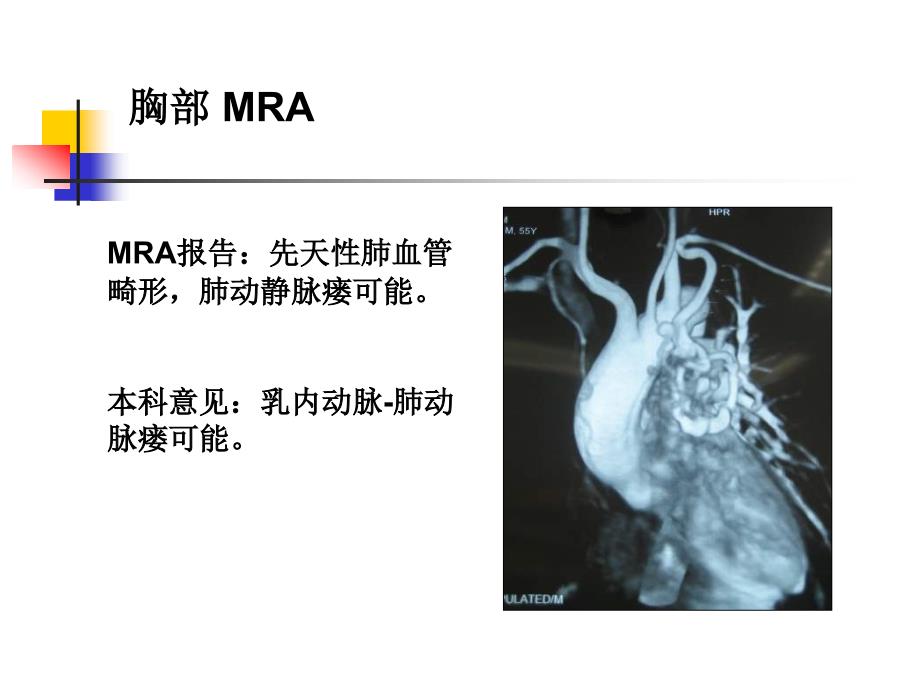 乳内动脉肺动脉瘘的介入治疗_第4页