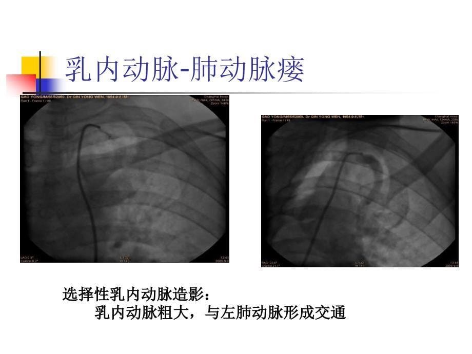 乳内动脉肺动脉瘘的介入治疗_第5页