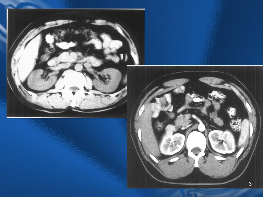 CT诊断学肾脏CTppt课件_第3页