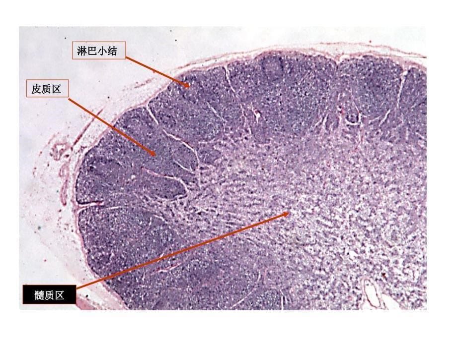 病理学淋巴造血系统疾病_第5页