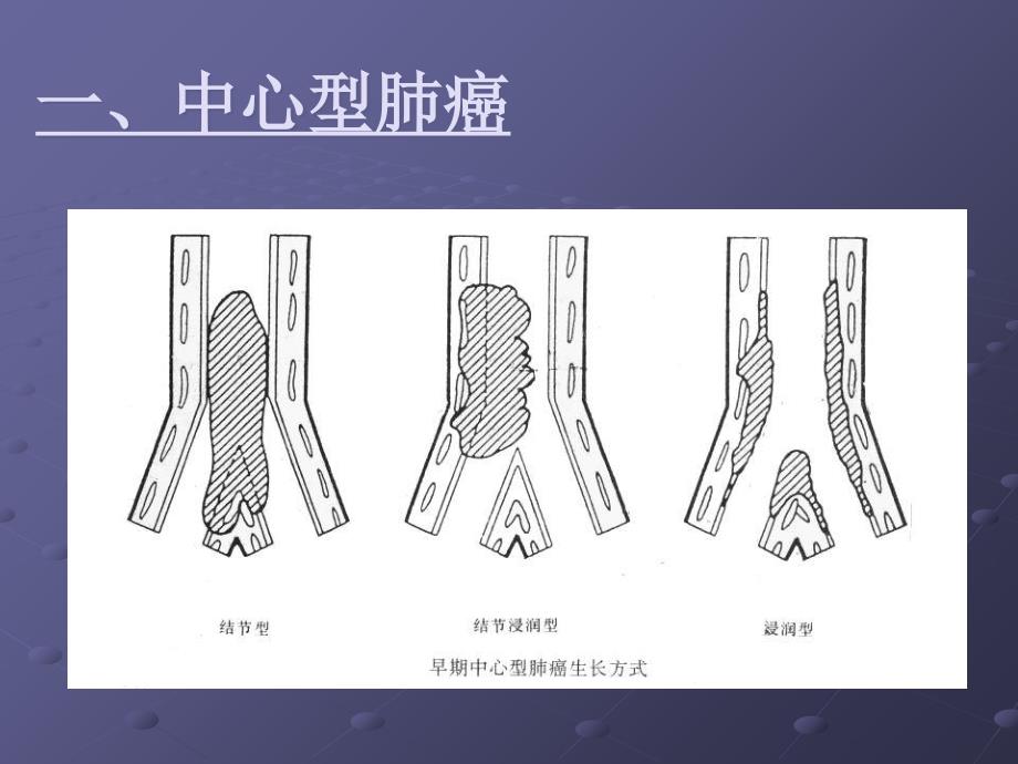 肺癌影像诊断讲_第3页