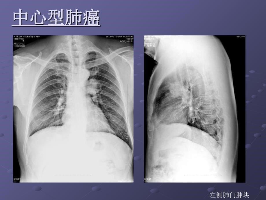 肺癌影像诊断讲_第5页