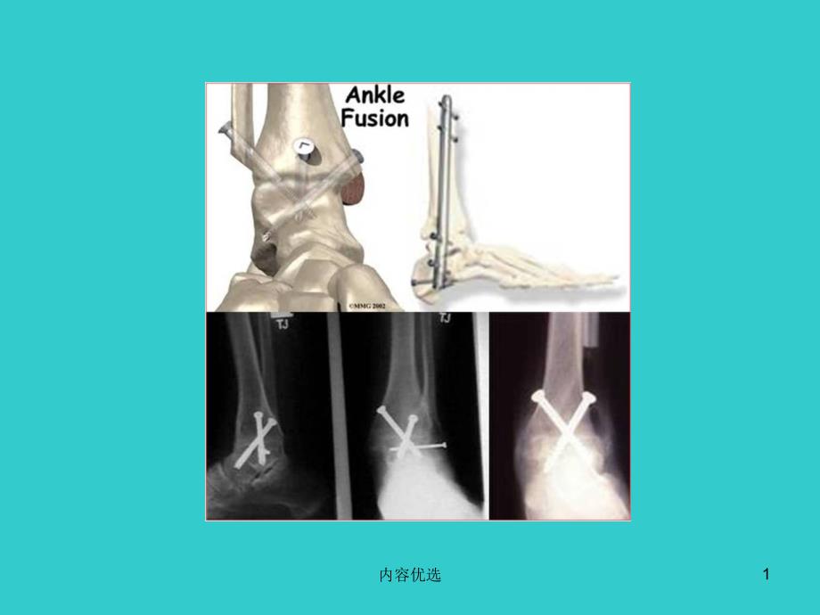 踝关节融合术的最新进展的讨论学习严选内容_第1页