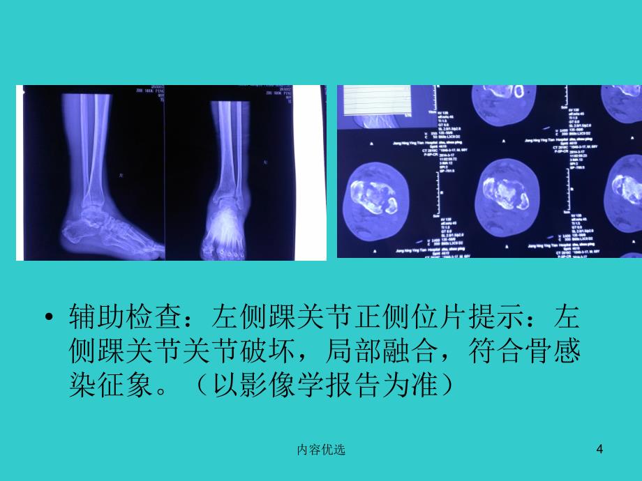 踝关节融合术的最新进展的讨论学习严选内容_第4页