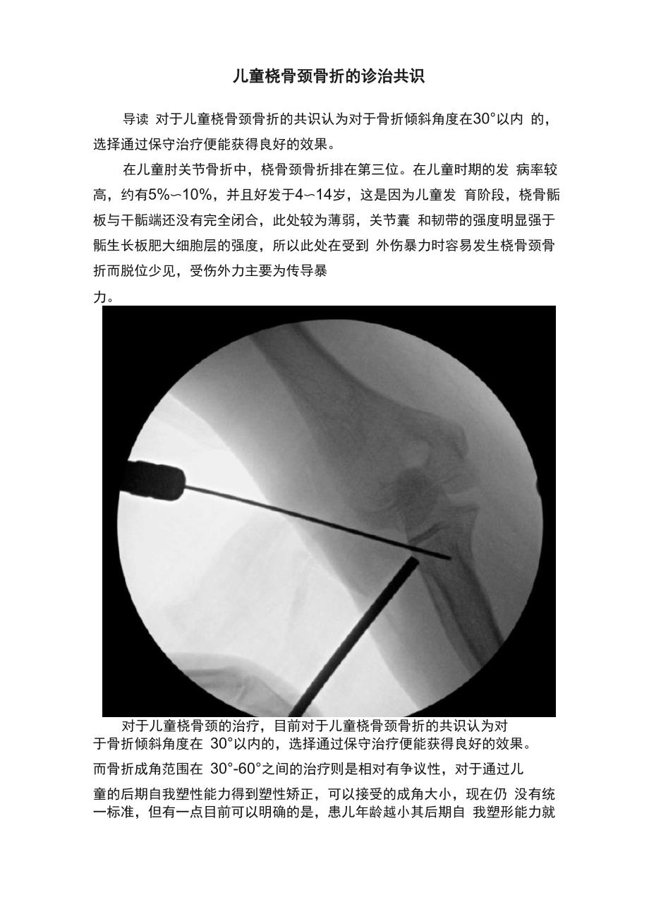 儿童桡骨颈骨折的诊治共识_第1页