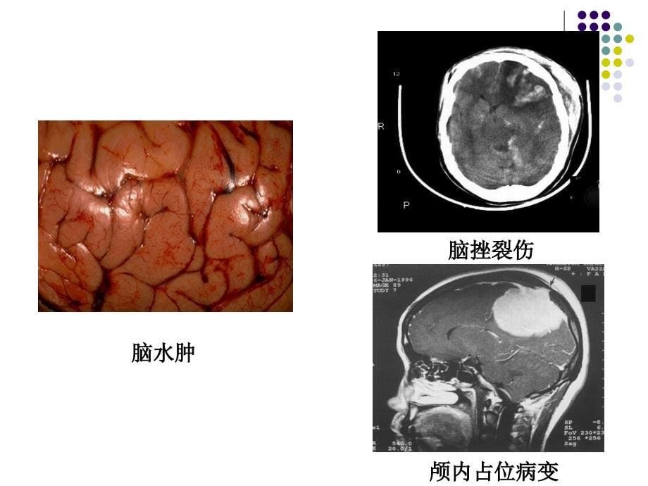 颅内压增高护理PPT课件_第5页