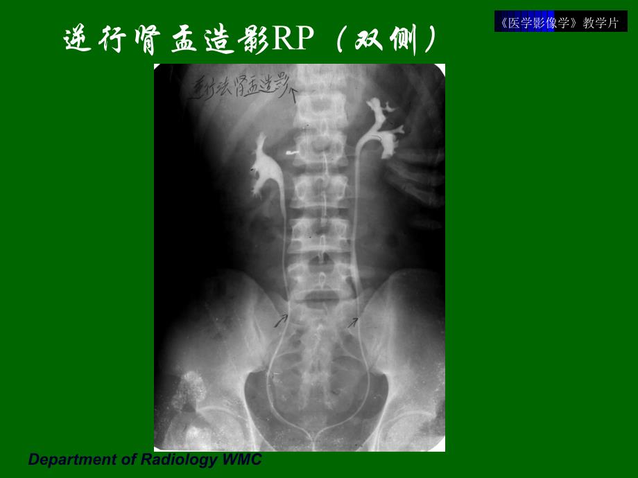 《医学影像学 》实验课件：教学片11-泌尿生殖系统_第4页