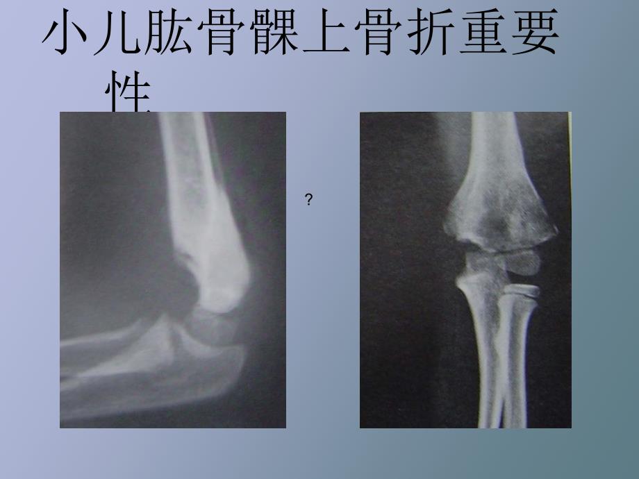 课件小儿肱骨髁上骨折_第2页