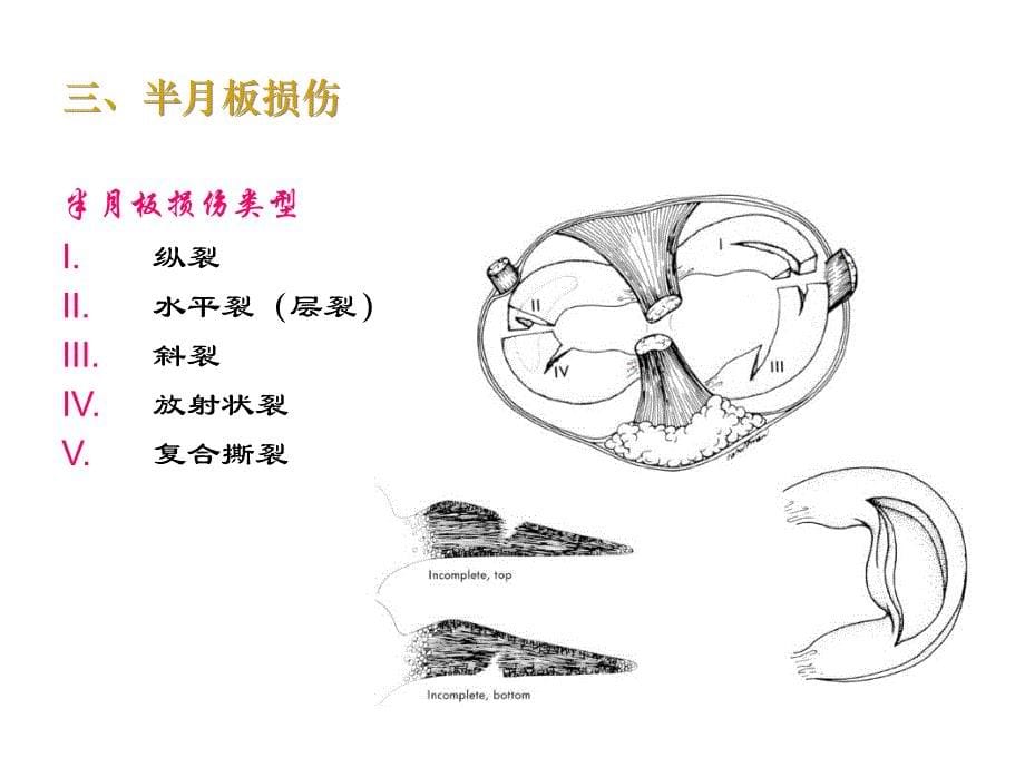 关节镜下半月板切除术手术配合_第5页