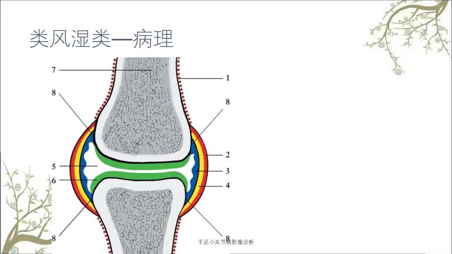 手足小关节病影像诊断_第4页