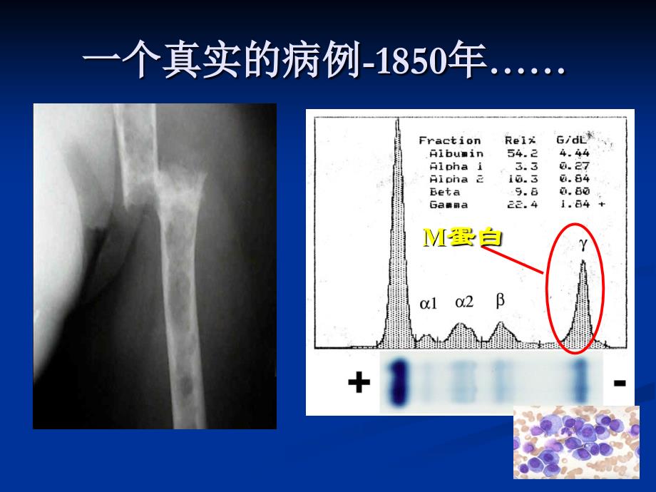 多发性骨髓瘤早期诊断和治疗_第3页