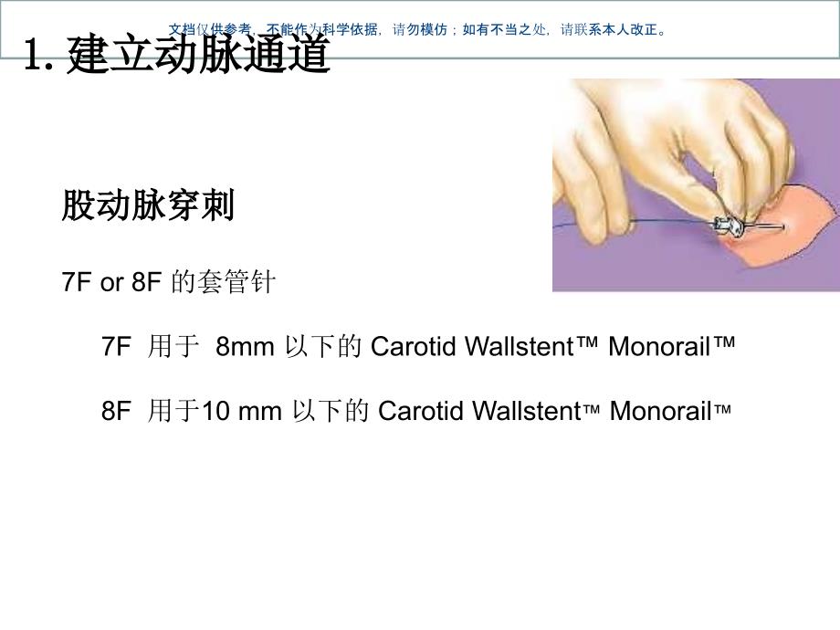 颈动脉支架手术步ppt课件_第2页