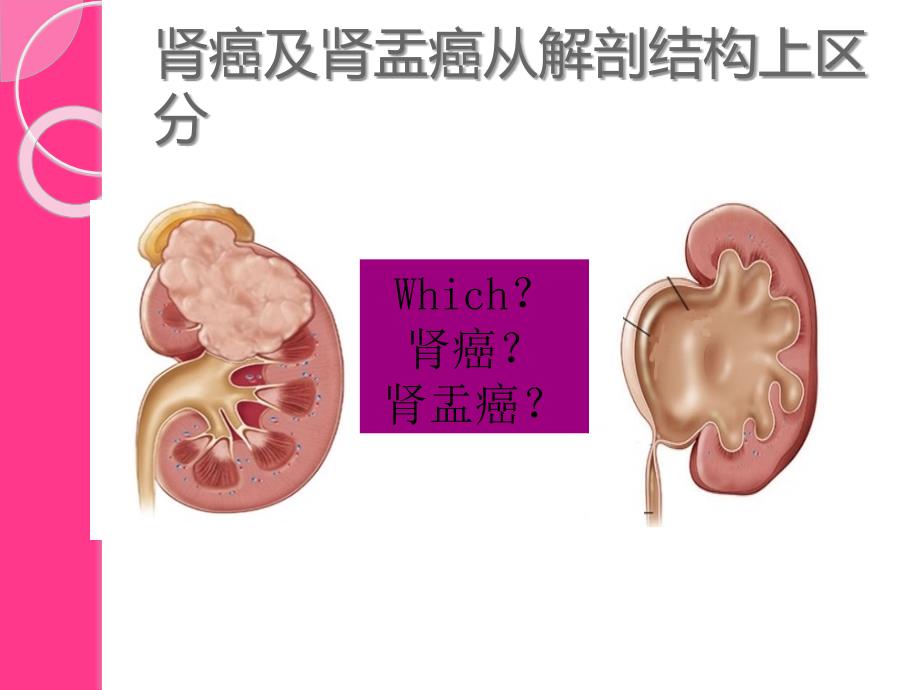 ICU常见泌尿科疾病的手术方式及_第3页