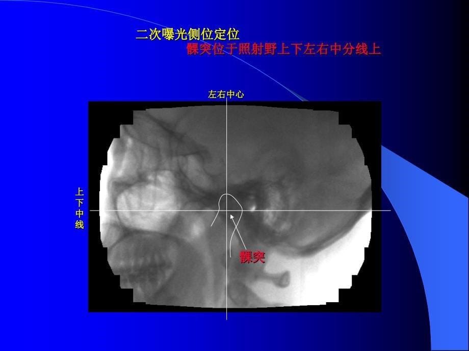 牙颌专用CT颞颌关节成像技术课件_第5页