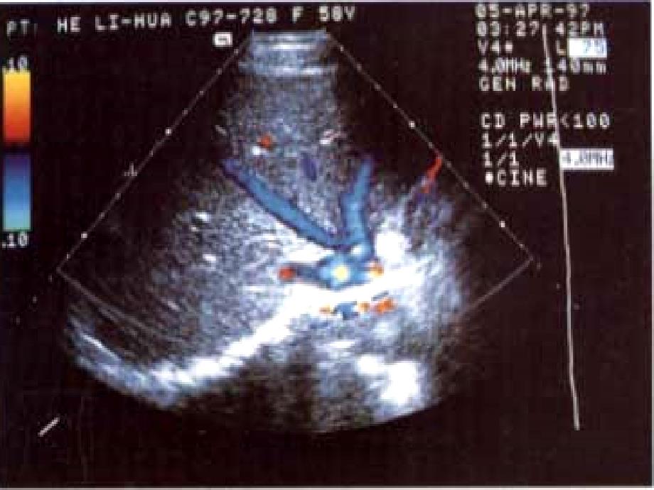 超声诊断学1肝脏PPT课件_第2页
