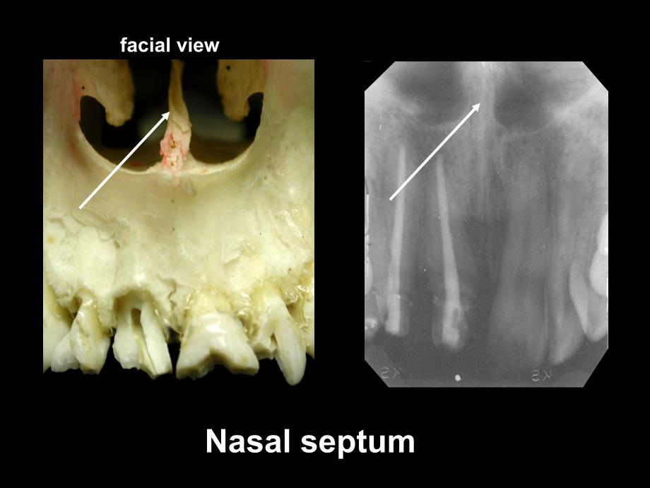 Intraoral Radiographic Anatomy(口内X线解剖)_第4页