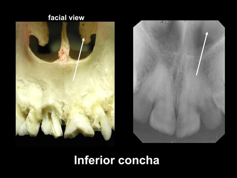 Intraoral Radiographic Anatomy(口内X线解剖)_第5页