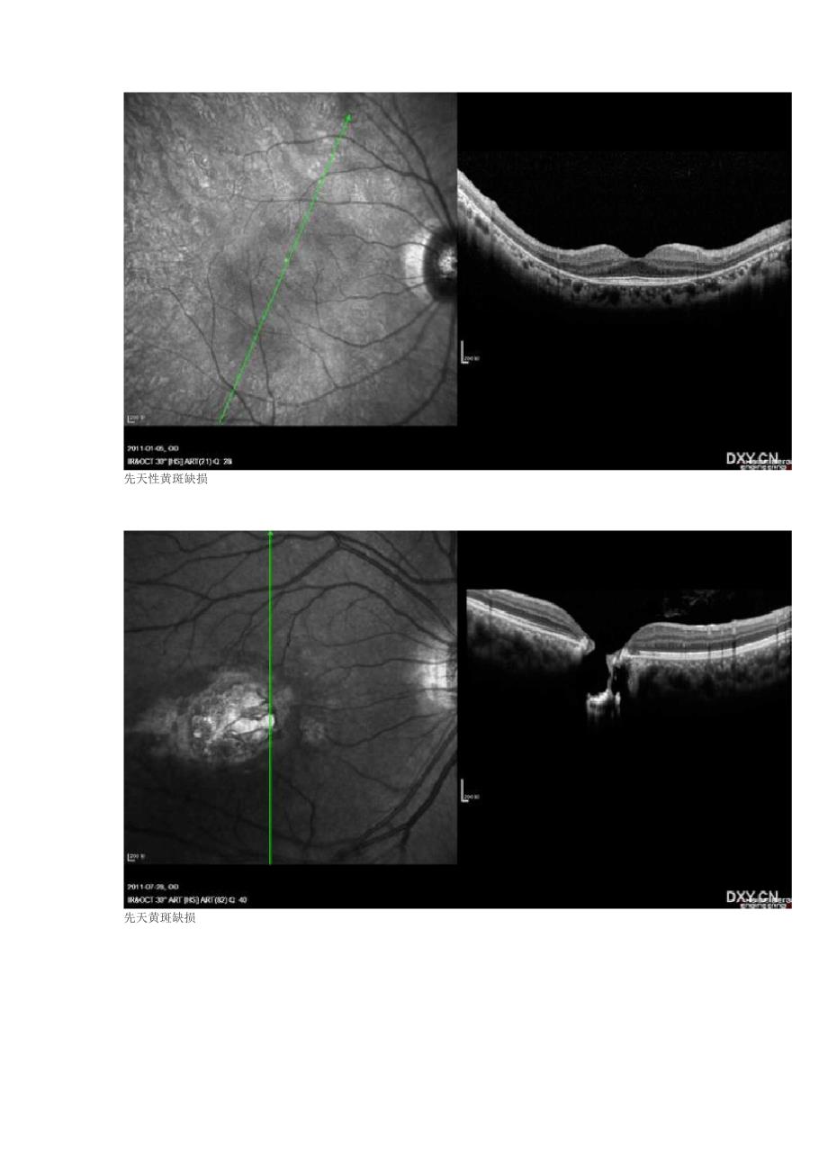 OCT视网膜10层结构_第3页