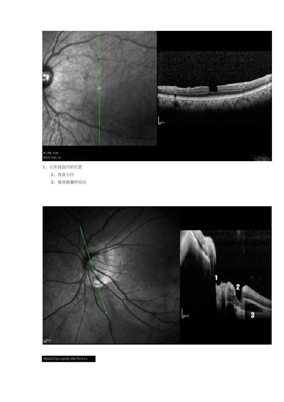 OCT视网膜10层结构_第5页