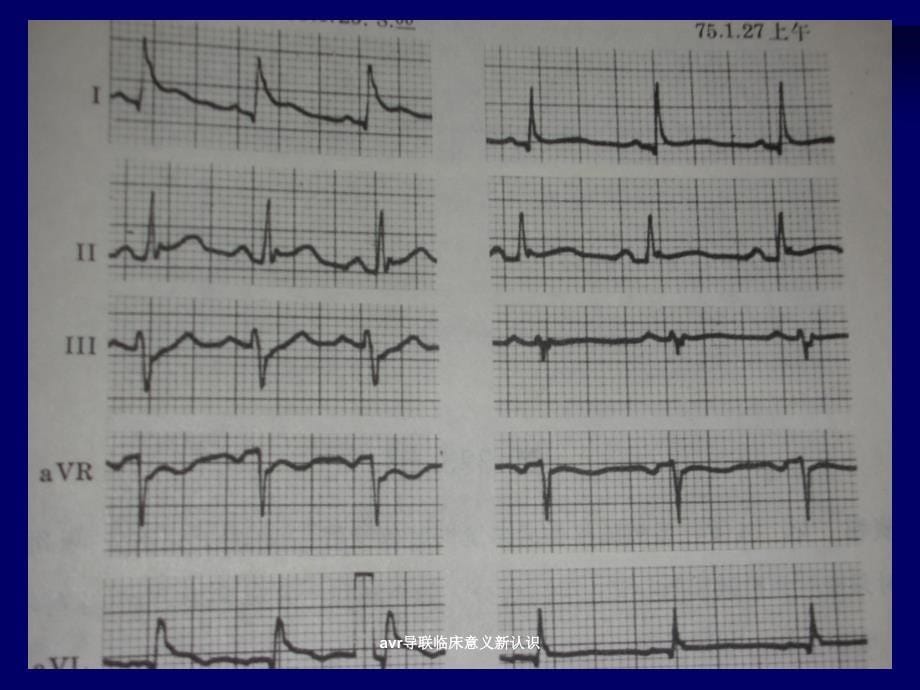 avr导联临床意义新认识课件_第5页