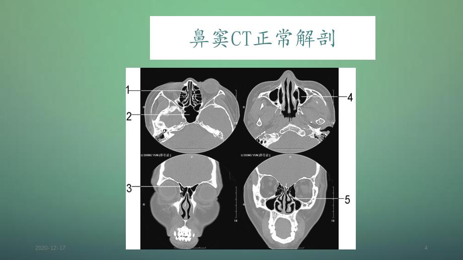 鼻鼻窦炎的影像学表现_第4页