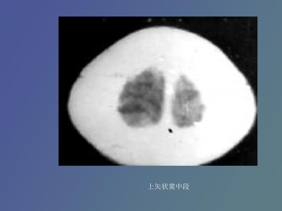 脑膜脑池脑室的CT解剖_第2页