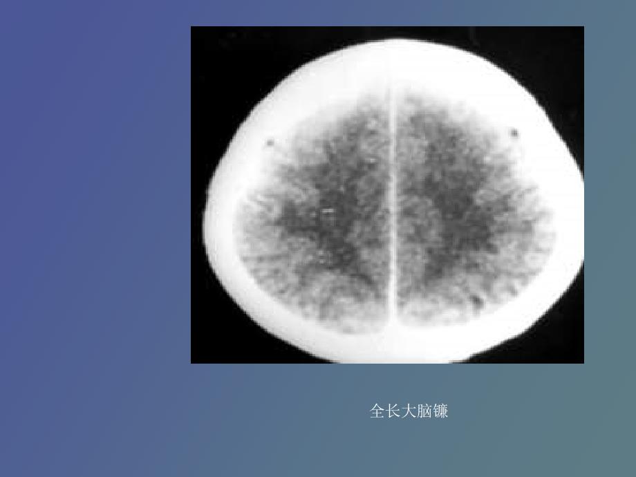 脑膜脑池脑室的CT解剖_第3页