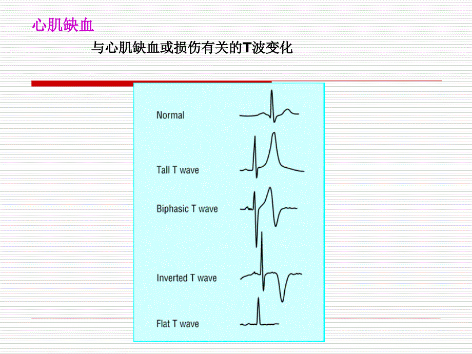 心肌缺血、损伤、心梗_第4页