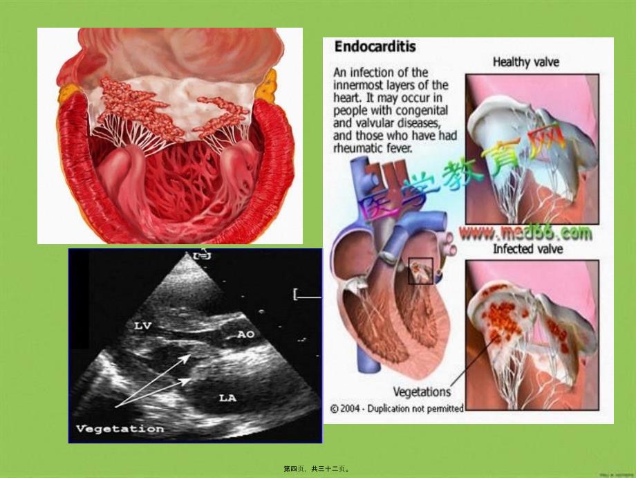 医学专题—感染性心内膜炎----赖柳兰9927_第4页