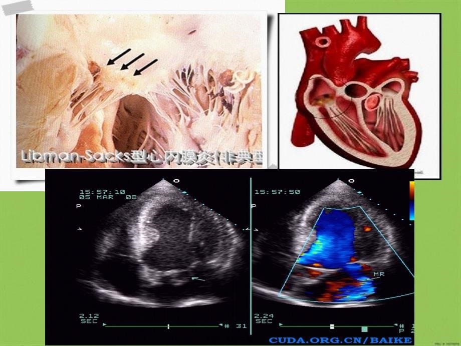 医学专题—感染性心内膜炎----赖柳兰9927_第5页