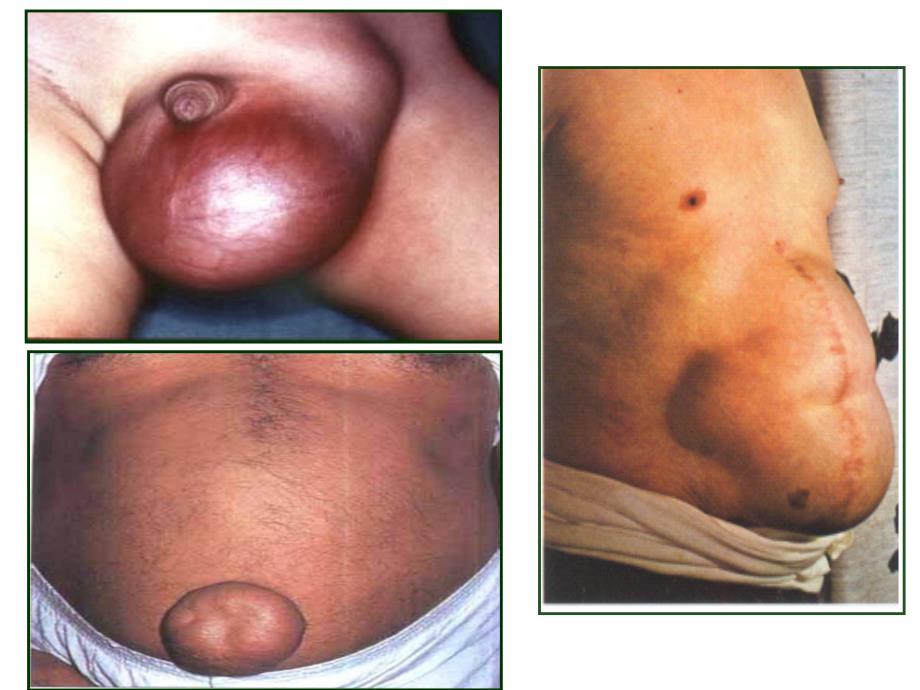 第十五章腹外疝病人的护理_第1页