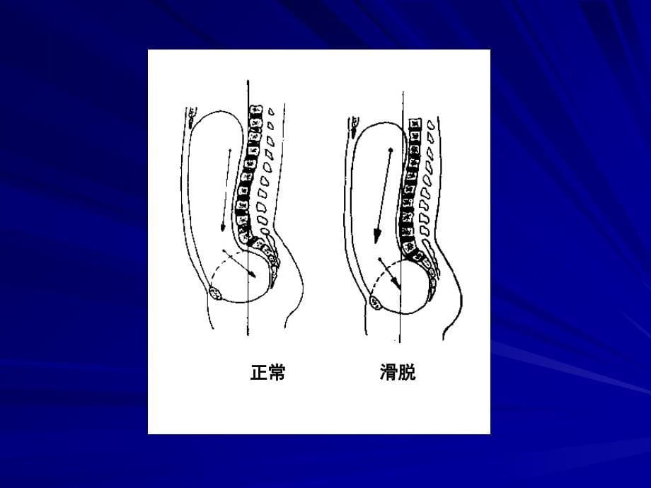 腰椎滑脱的阶梯疗法资料讲解_第5页